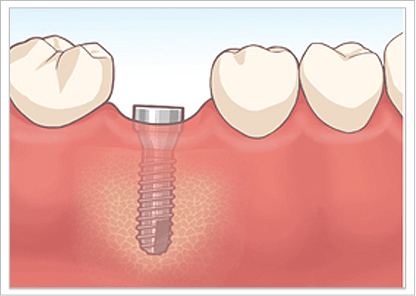 インプラント